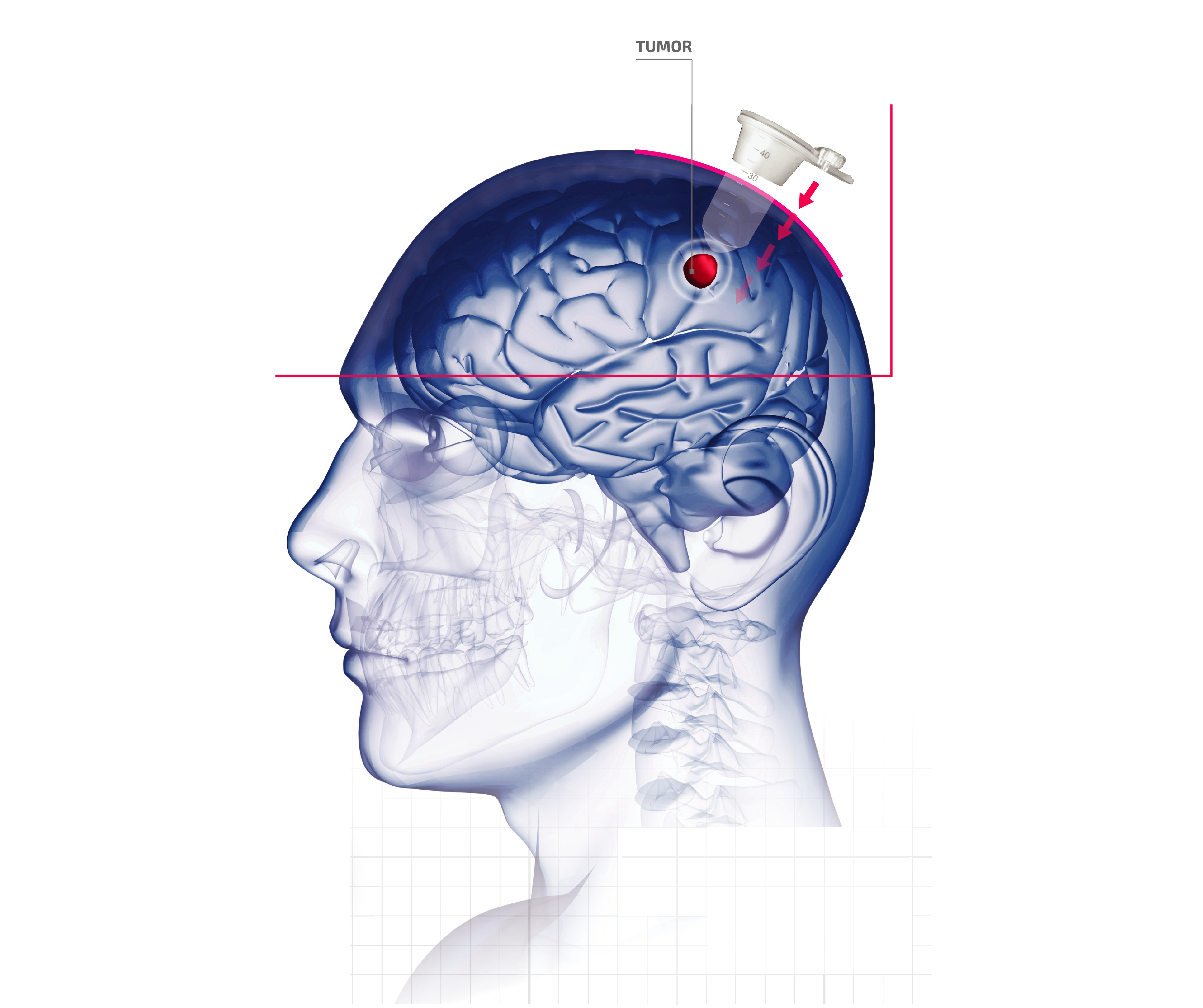 NeuroEndoView Plus