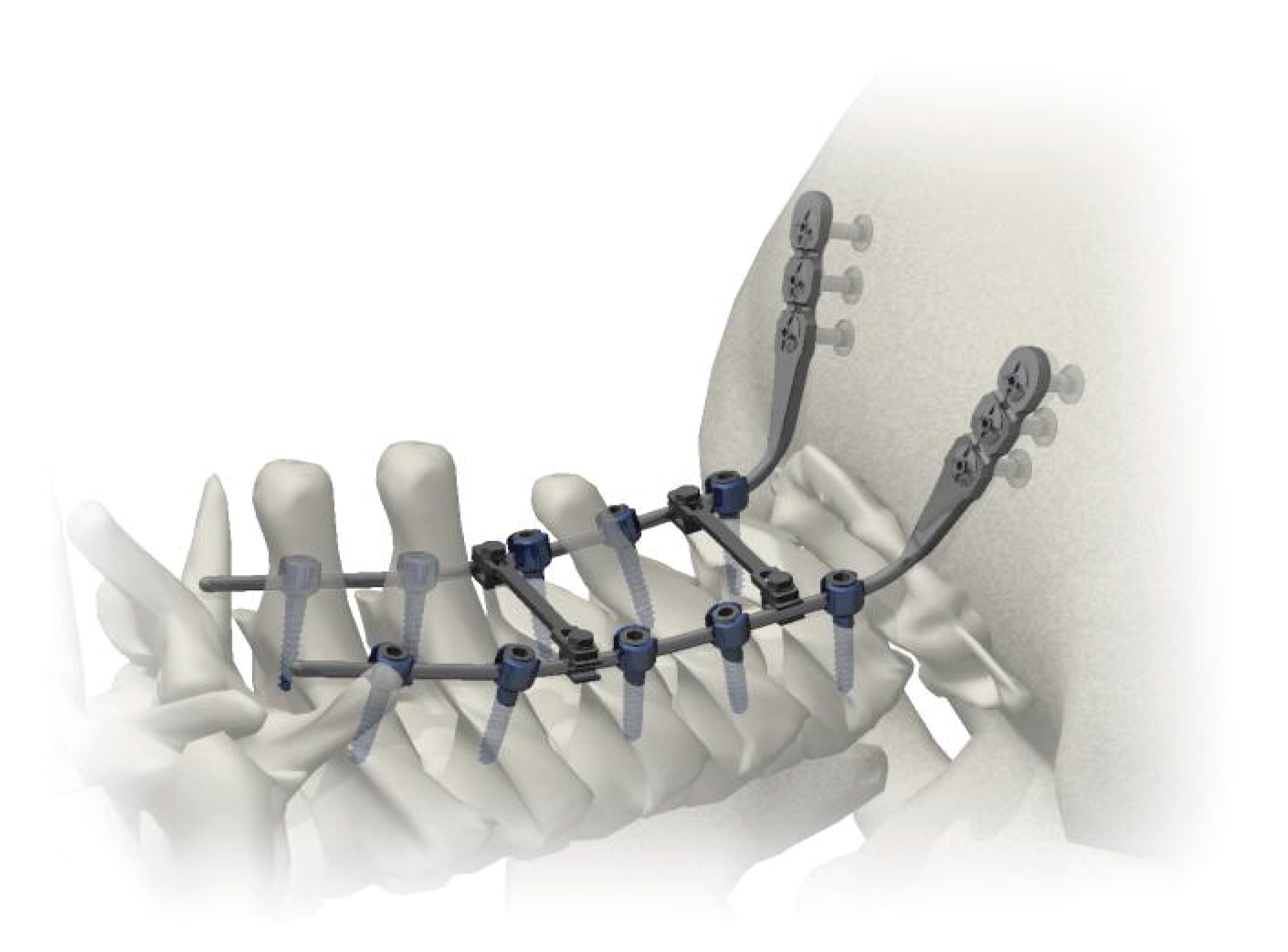 IMPLANTES OCCIPTO CERVICAL